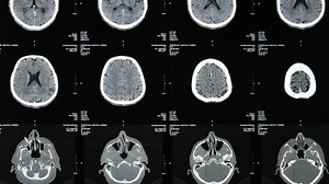 Treating brain cancer with immunotherapy