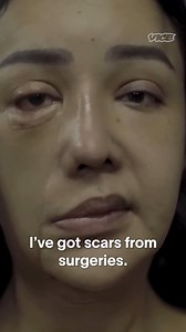 67K views · 163 reactions | In Thailand, an unregulated cosmetic enhancement industry is thriving. Botched procedures undertaken by unlicensed practitioners are leaving patients disfigured and forced to spend thousands on reconstructive surgery. | VICE | Facebook