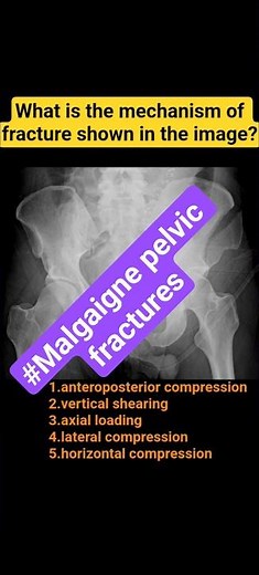 #Malgaigne pelvic fractures #shorts