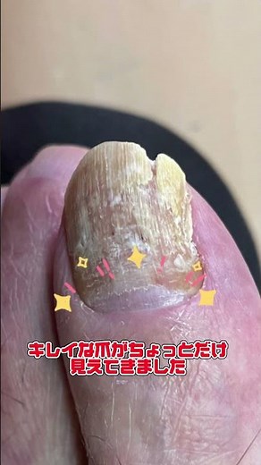 爪水虫、飲み薬ネイリンでここまで治りました！ #爪白癬 #爪水虫 #ネイリン #皮膚科 #美容皮膚科 #こはく皮フ科クリニック #こはく皮膚科クリニック #豊田市に開業予定