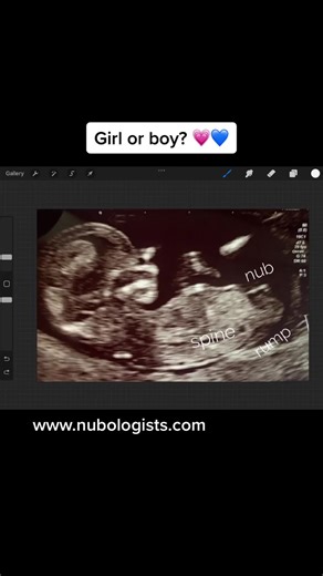 Gender Reveal: Nub Boy or Girl at 12 Weeks Ultrasound