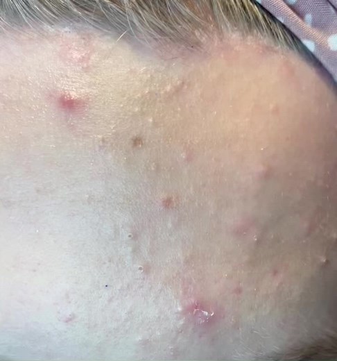 #pimplepoppingvideos #pimplepopping #pimple #foryoupage #satisfying #gross #fyp #discusting