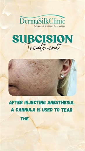 Say Goodbye to Acne Scars The Power of Subcision Explained | DermaSilk Clinic Toronto