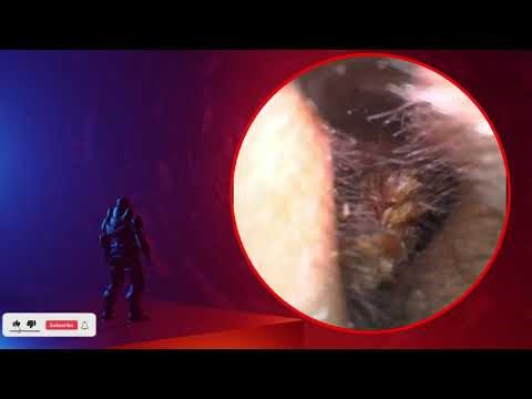 The Truth About earwax Will Shock You. How to remove earwax from ear, earwax extractions