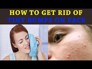 How to Get Rid of Tiny Bumps on Face | How to Get Rid Of Pimples in 5 Minutes With Home Remedies