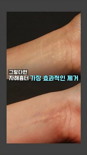 자해흉터, 수술로 없애기 어렵다? | 주저흔, 칼에 베인 흉터 치료&없애는 법(제거법) 알려드립니다.