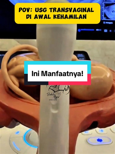USG transvaginal di awal kehamilan sangat penting karena memiliki banyak manfaat spesifik di trimester pertama. USG transvaginal biasanya dilakukan untuk: • Memastikan lokasi kehamilan (di dalam atau di luar rahim/kehamilan ektopik) • Menentukan usia kehamilan • Melihat perkembangan embrio • Mendeteksi detak jantung janin lebih awal mulai minggu ke-5 • Membantu mencari penyebab perdarahan atau nyeri pada awal kehamilan #ibuhamil #kehamilansehat #trimester1 #usgtransaginal #edukasitiktok
