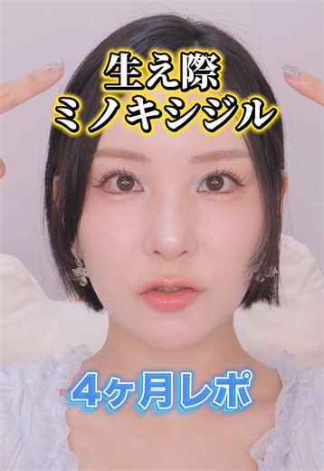 生え際ミノキシジル4ヶ月レビュー｜効果と経過写真まとめ