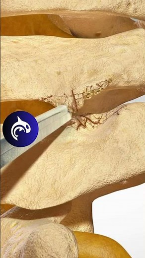 See what a Posterior Cervical Foraminotomy of the Spine looks like in a 4K 3D animation.