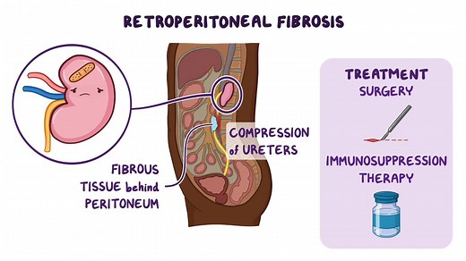 Video: Retroperitoneal fibrosis: Year of the Zebra - Video Explanation! | Osmosis | Osmosis