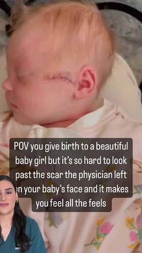 Reacting to this video of a baby left with a scar from birth. While the situation may have been difficult, it’s important to remember that the baby is healthy and without other complications. Scars can remind us of the past but can also be a sign of strength. It’s all about perception. If you’re struggling with scars, visit SHI.org to see how we can help. #scarcare #birthscars #scarhealing #perceptionmatters #skincare #healthybaby #strengththroughscars #scarremoval #skinhealth #SHIlase #scarredb