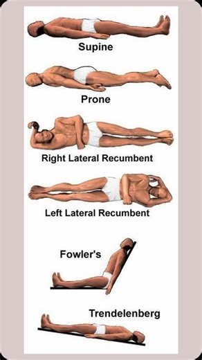 Hospital patients positions-Here are some common patient positions: * Supine: * Lying on the back. * Prone: * Lying on the stomach. * Lateral: * Lying on the side. * Fowler’s: * Sitting with the head of the bed elevated. * Trendelenburg: * Lying on the back with the head lower than the feet. * Reverse Trendelenburg: * Lying on the back with the head higher than the feet. * Lithotomy: * Lying on the back with knees flexed and thighs apart. * Sims’ Position: * Laying on the left side with the left