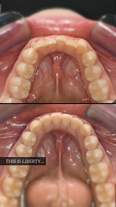 143K views · 1.5K reactions | Treated by the Orthodontics Department @libertydentalclinic #drmohammednaji #dentistry #dubaidentist | Dr. Mohammed Naji | Facebook