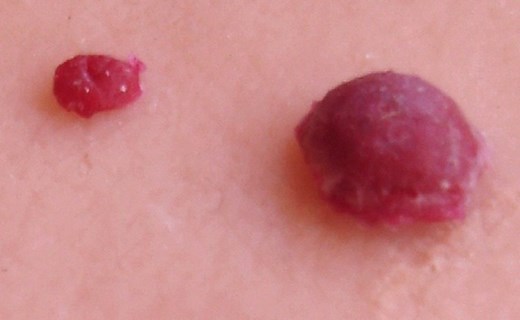 Cherry Angiomas - Pictures, Symptoms, Causes, Treatment, Removal