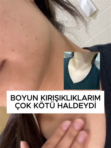 boyun kırışıklıklarımı tamamen yok ettim #salyangozkremi #sarkmalar #wrinkles #ciltsarkması #kırışıklıktedavisi