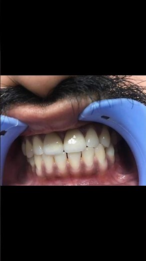 EMAX crown for anterior teeth