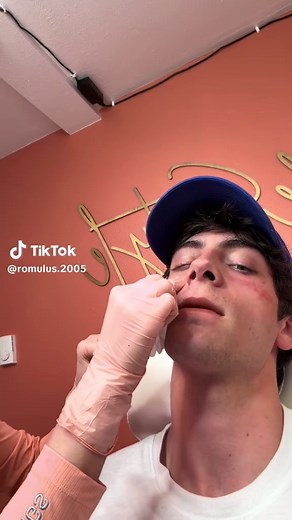 Just use your own Plasma to stimulate Growth Factor (it’s not filler) | plasma
