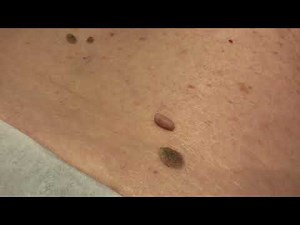 Skin Tag Removal using our CryoPen™
