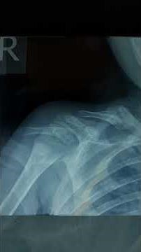 fracture clavicle healing stages on two months
