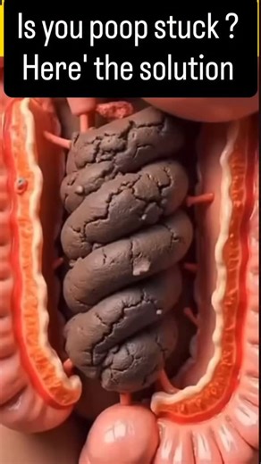 Body healing 101 on Instagram: "🚽💥 Is Your Poop Stuck? Here’s the Natural Fix! 💥🚽 If your digestion feels sluggish, try this simple home remedy to get things moving — safely and naturally! 🌿 Recipe: 🧂 1 tsp salt 🍬 1 tsp sugar 🍋 Freshly squeezed lemon juice 💧 1 cup of water Boil the water with salt and sugar for 5 minutes, then remove from heat and stir in the fresh lemon juice. Drink this before a meal once a day. 💡 