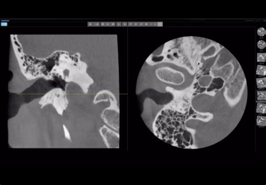 颞骨CT阅片［油管搬运］［自翻］How to Read Temporal Bone Imagining