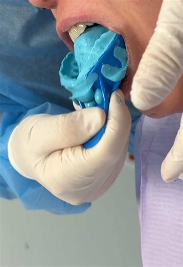 Large Upper Blueberry Mold Impression: Dental Technique Explained