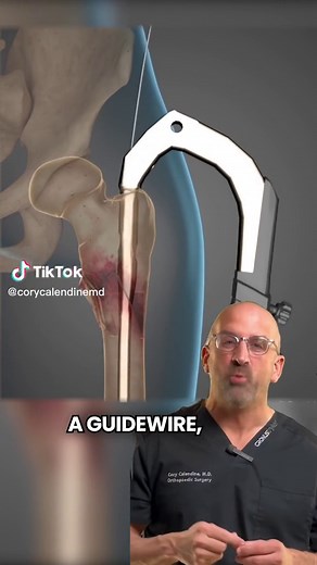 Hip Fracture Surgery Explained: Femoral Nail Procedure