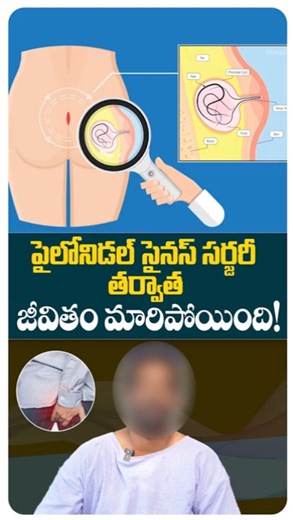 Buttock Hair Removal for Men | Prolonged Sitting Effect | #ytshorts #healthtips #pilonidalsinus