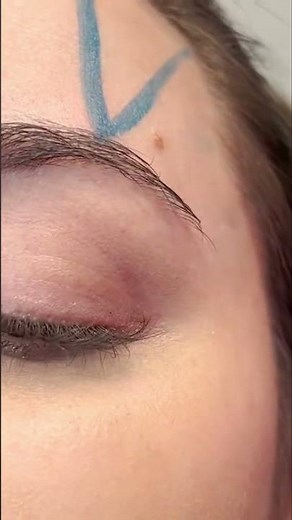 Skin Transformation @Puar.Medspa in Lake Mary. #Shorts