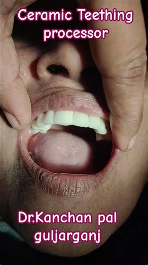 Ceramic Teething processor #dentist #dentalcare