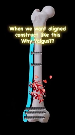 Issue of Valgus Mal-reduction in Distal femur plating #fracture #ortho