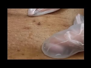 BIKINI 🤤🤤 BLACKHEADS INGROWNS REMOVAL!