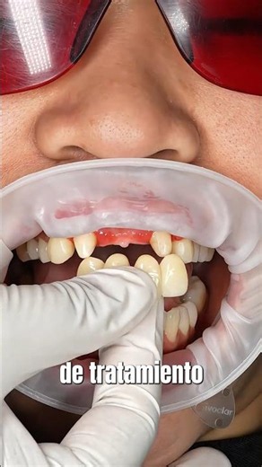 Dental implants without screws: Should you use this fixed prosthesis?