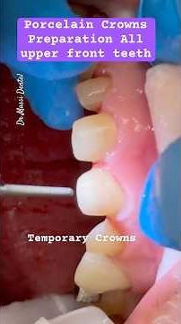 Upper Front teeth Crowns Preparation with temporary video