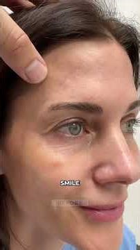 Endobrow and upper blepharoplasty- before and after