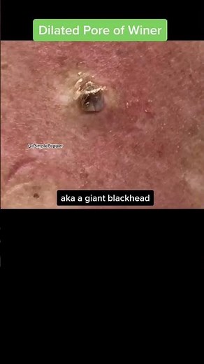 The Best DPOW of All-Time! Throwback Thursday with Dr Pimple Popper
