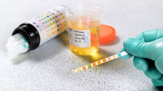 Bandelettes urinaires : quel est rôle d’un test urinaire ?