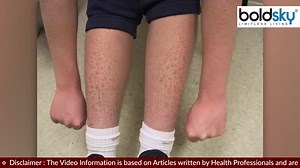 3 comments | What is Ichthyosis vulgaris Disease, Symptoms Reason Treatment | *Health Ichthyosis vulgaris is a genetic disease. Ichthyosis vulgaris is a skin disease in which dead skin cells build up on the surface of your skin in a thick and dry manner. Let's know who gets this disease and why #Ichthyosisvulgaris #skindisease #boldsky | Boldsky | Facebook