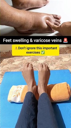 Varicose veins & Feet swelling? try this exercises ✅ #ankleswelling #varicoseveins #shorts #foot
