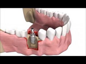 How DENTAL IMPLANTS are inserted | 3D simulation
