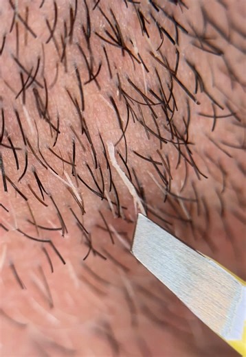 Plucking Thick Beard Hairs: A Satisfying Skincare Routine