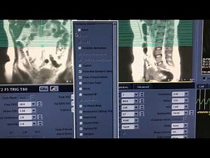 No Phase Wrap Tutorial Ressonância Magnética GE.