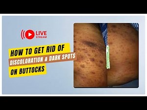 How to get rid of Hyperpigmentation and Dark Spots on Butt