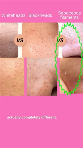 That's Not a Blackhead.. Stop Squeezing!