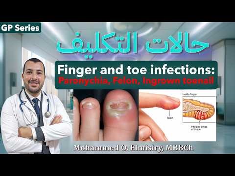 Paronychia Explained: Diagnosis, Drainage & Surgical Management | GP Course