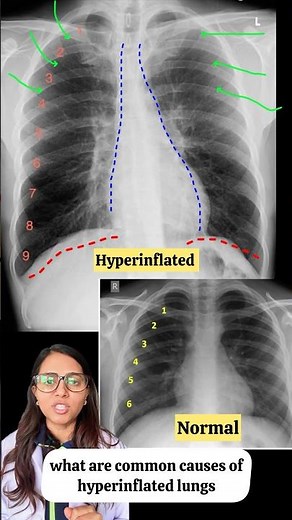 Hyperinflated lungs! #radiology #xray #pulmonologist #mbbsstudent #medicalschool #neet2024 #usmle
