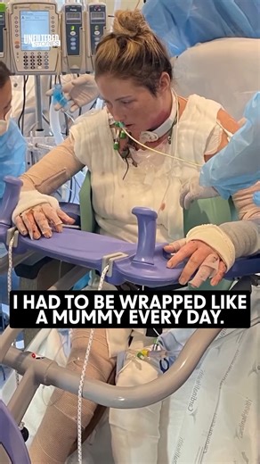 An Explosion Burned 85% Of My Body - Part 2 | Miracle Survivors