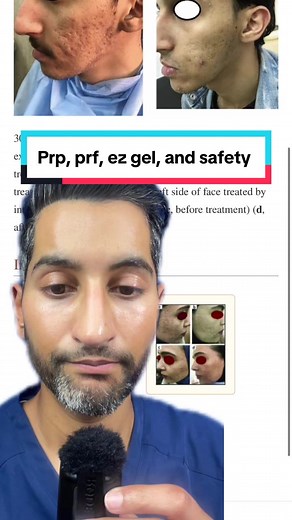 Risks and Safety of PRF Eye Treatment Explained by Dr. Prem Tripathi