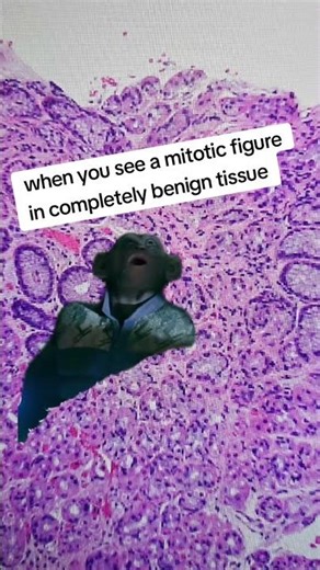 Mitotic Figure (pathologists will understand)