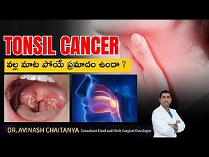 What are the symptoms of tonsil cancer | Dr.Avinash Chaitanya | Kaizen Hematology Oncology Network